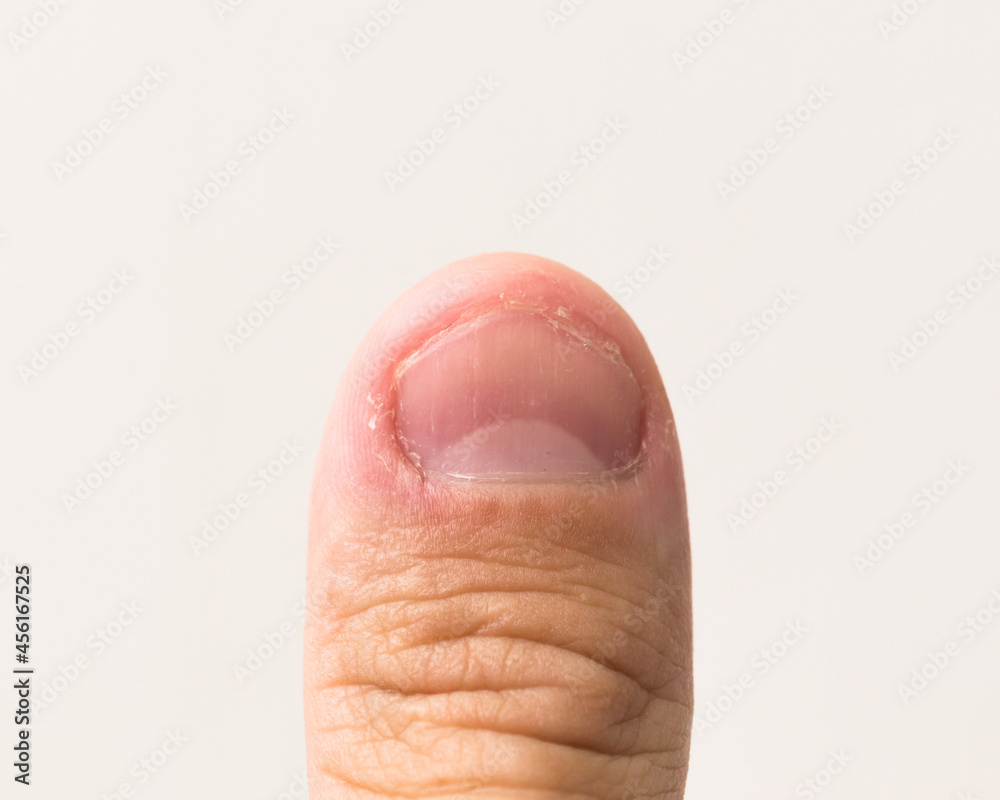 Fingers with dry fingernails On a gray background Fingers with dry fingernails On a gray background