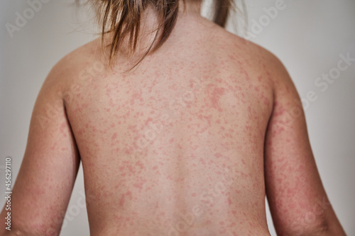 allergic rash on the body of the patient. 5 year old girl.