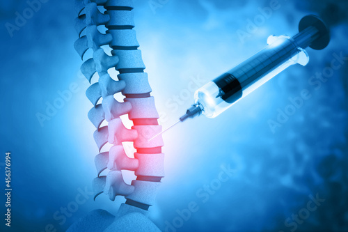 3d illustration of a lumbar spine injection photo