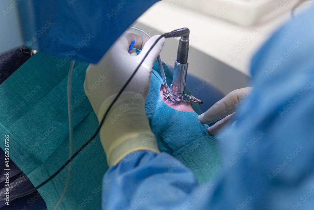 Detail of an ophthalmological operation of an eye Detail of an ophthalmological operation of an eye
