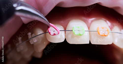 Fotografija Close up of doctor installing colorful elastic rubber bands to patient brackets