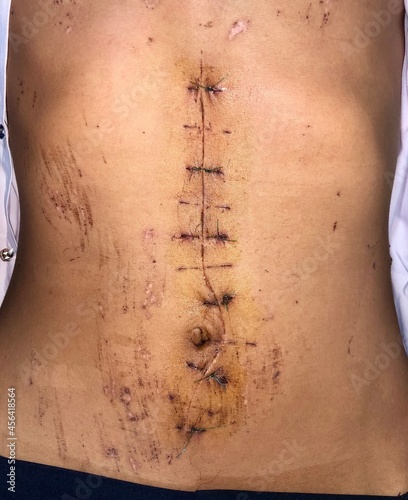 Laparotomy or midline incision at the abdomen. photo