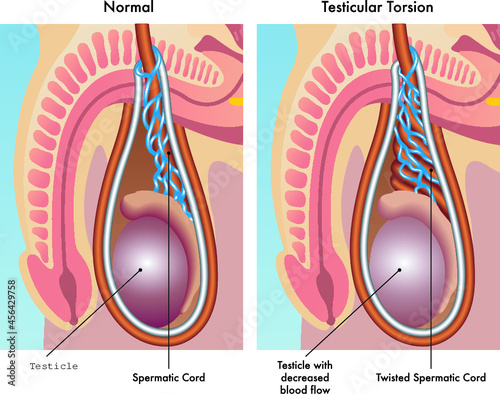 Medical illustration shows a normal testicle and one affected by testicular torsion, with annotations.