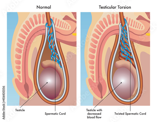Fotografi Medical illustration shows a normal testicle and one affected by testicular torsion, with annotations