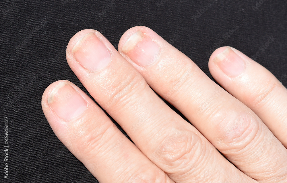 Fungal nail infection, onycholysis after shellac or gel-varnish Stock ...