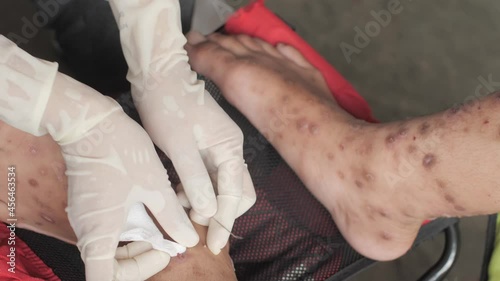 Nurse hand cleaning patient foot with ulcer filled with pus condition caused of scabies infection, sensitive skin itchy health problem