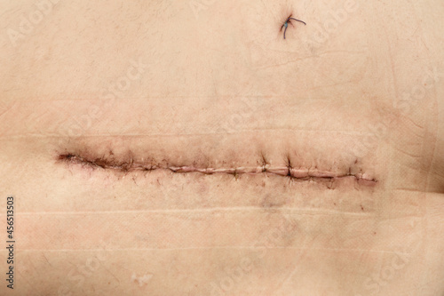 Postoperative suture on human skin