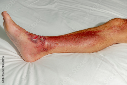 Fotografie Health care and medical concept, Selective focus of a man leg and foot laid on white bed linen with blisters, Fresh wound from skin burns on ankle, Accident hot water fall with scald on a men feet