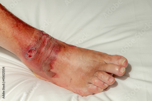 Konstfotografi Health care and medical concept, Selective focus of a man right foot on white bed linen with blisters, Fresh wound and blood from skin burns on ankle, Accident hot water fall with scald on a men feet