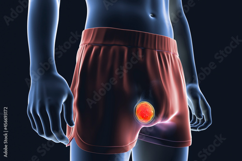 Quadro em tela Testicular cancer, 3D illustration