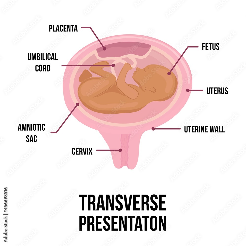 Fototapeta premium transverse baby presentation. wrong baby positions in uterus during pregnancy. Colored medical vector illustration.