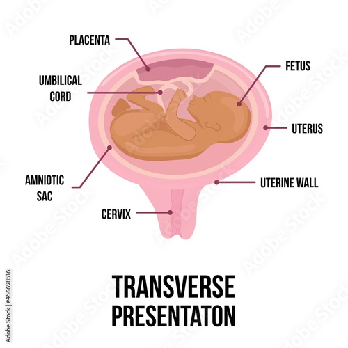 transverse baby presentation. wrong baby positions in uterus during pregnancy. Colored medical vector illustration.