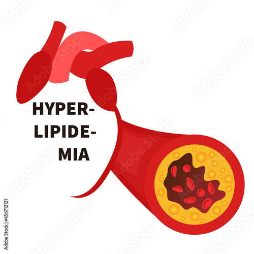 Hyperlipidemia disease awareness poster. Heart and narrowed blood artery vessel blocked with a clot. High cholesterol risk factor. Medical concept. Vector illustration. photo