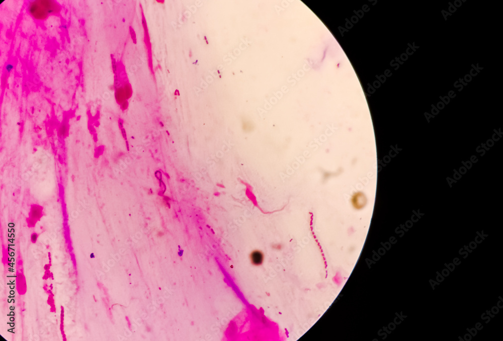 Grams stain microscopic focus, Streptococci are chains of cocci, gram