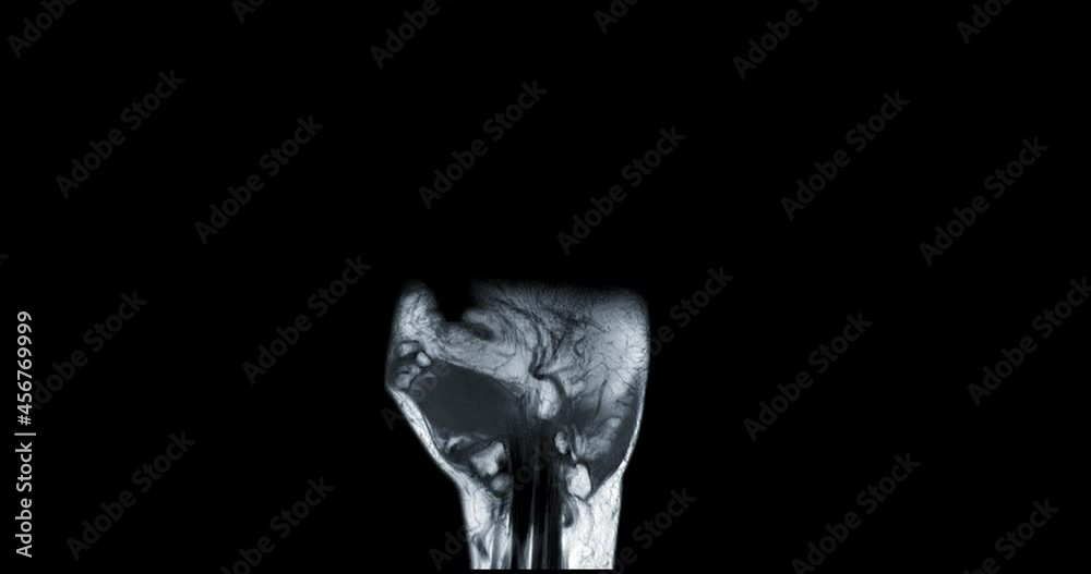 MRI hand coronal t1w for diagnosis bone arthritis and rheumatoid. MRI hand coronal t1w for diagnosis bone arthritis and rheumatoid.