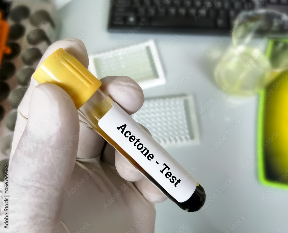 Blood sample for acetone test, diabetic ketoacidosis or alcoholic