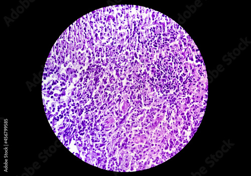 A histological slide of a tissue sample. Close microscopic view. Histopathology, Cytopathology (FNAC) fine needle aspiration cytology, Malignant cell photo