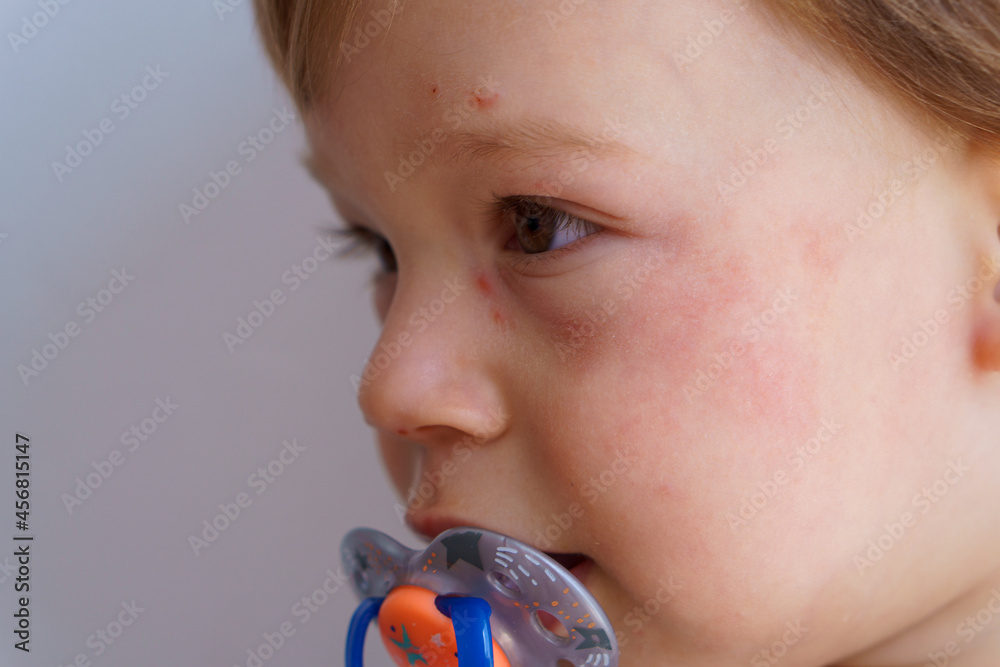 Health, dermatology, pediatrics, disease dermatitis concepts closeup