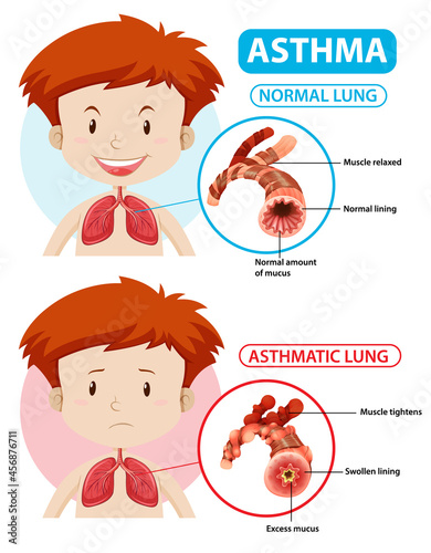 Asthma diagram with normal lung and asthmatic lung