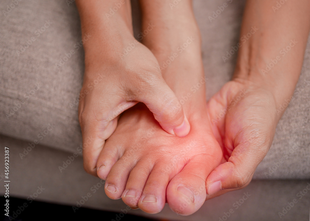 Closeup of female holding her painful feet and massaging her bunion toes to relieve pain. Swollen bunion at the edge of the big toe causes deformity (Hallux valgus). Woman's health concept. - obrazy, fototapety, plakaty 