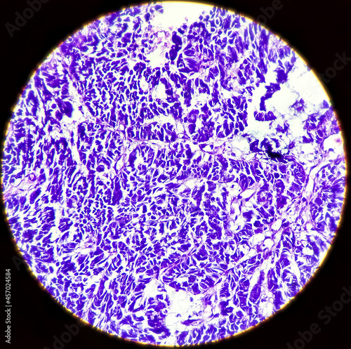 Cancer of Esophagus: Poorly differentiated adenocarcinoma in a patient. Tumor cells undermine the esophageal squamous mucosa.