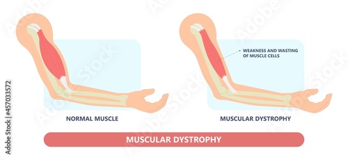 Muscle myopathy gene DNA cell damage Becker type Limb Girdle x linked Distal Emery loss Lack fibres tissue biceps arm spine weaken gait lumbar calf sign Gower lower exam fatigue Physical genetic stand