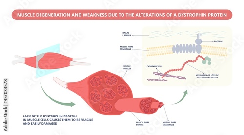 Muscle myopathy gene DNA cell damage Becker type Limb Girdle x linked Distal Emery loss Lack fibres tissue biceps arm spine weaken gait lumbar calf sign Gower lower exam fatigue Physical genetic stand