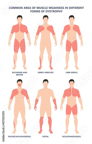 Muscle myopathy gene DNA cell damage Becker type Limb Girdle x linked Distal Emery loss Lack fibres tissue biceps arm spine weaken gait lumbar calf sign Gower lower exam fatigue Physical genetic stand