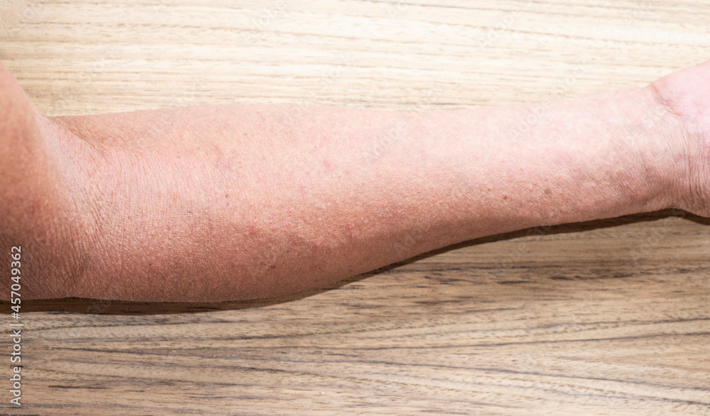 The skin on the arm of an elderly person with symptom of inflamed skin