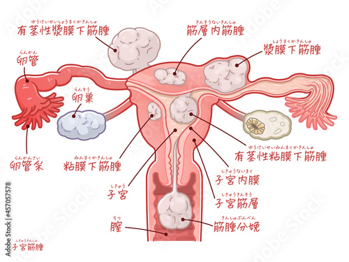 子宮筋腫の子宮、卵巣、卵管のイラスト、illustration photo