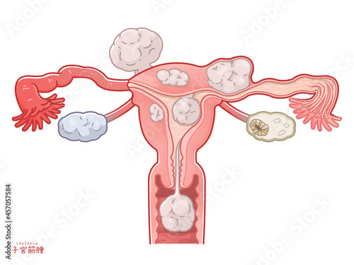 子宮筋腫の子宮、卵巣、卵管のイラスト photo