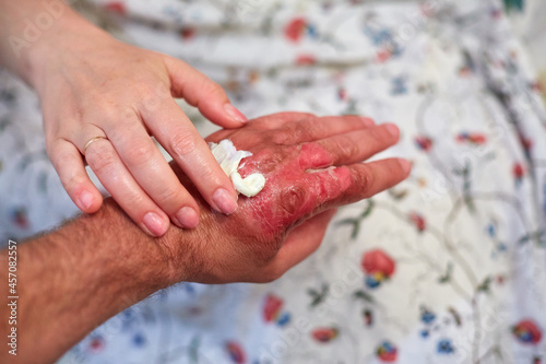 use of healing ointment after burns, first aid for body burns