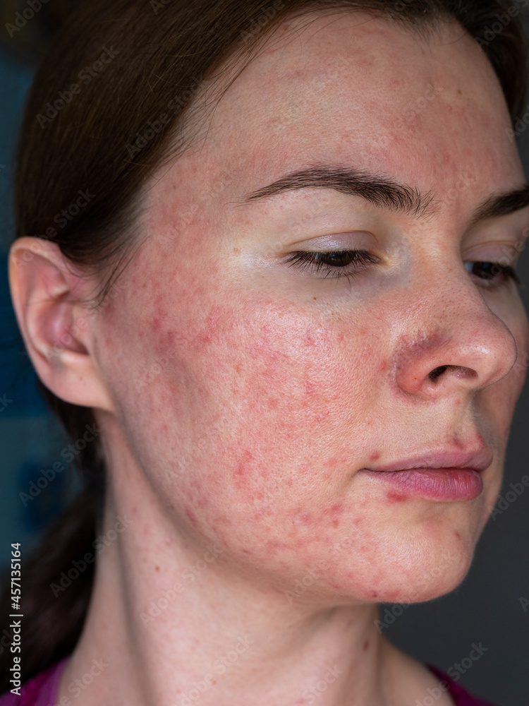 Obraz premium close-up of the skin of a patient with papulopustular rosacea