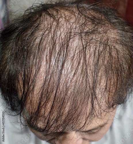 Thinning or sparse hair, male pattern hair loss photo