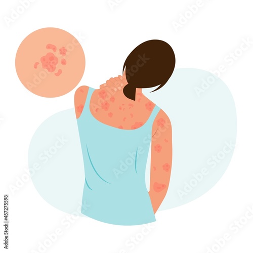 The woman is scratching her back.  Pustular psoriasis.Allergic itching, skin inflammation, redness and irritation. Atopic dermatitis, eczema, psoriasis, dry skin. Skin problems photo