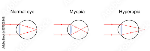 Illustration of light diagram on normal eye, myopia, and hyperopia. photo