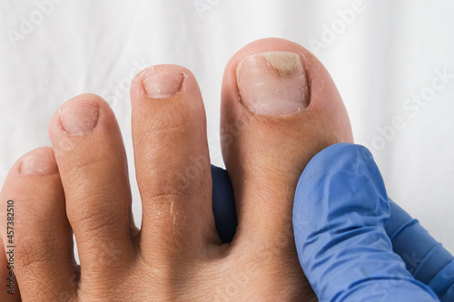 A podologist examines bare foot with onycholysis on a toenail after damaging with tight shoes or using gel-lacquer photo