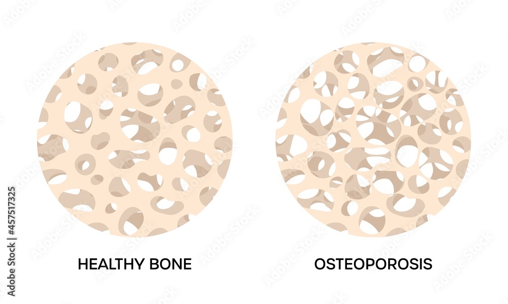 Healthy and osteoporosis bone, round illustrations on white background