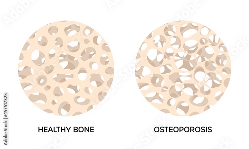 Healthy and osteoporosis bone, round illustrations on white background