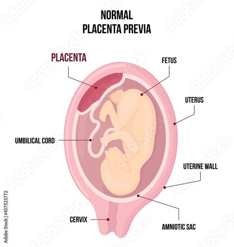 Normal Placental previa Fototapet