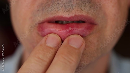 recurrent aphthous ulcers or canker sores, sore lip. Aphthous stomatitis,  benign and non contagious mouth ulcers. Canker photo