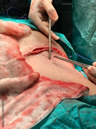 Suturing in surgery