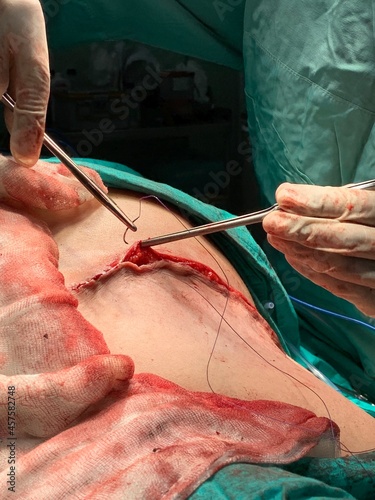 Suturing in surgery