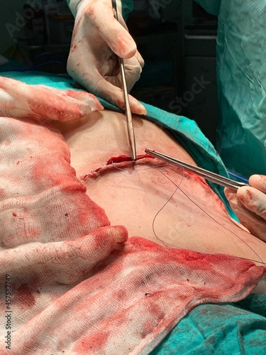 Suturing in surgery