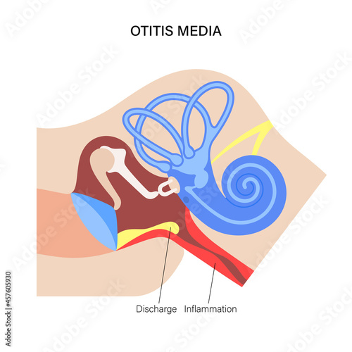 otitis media disease