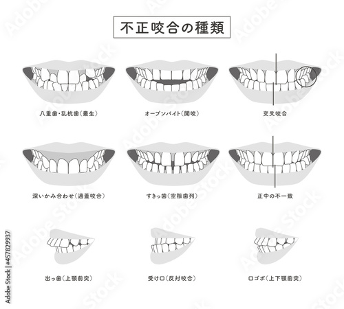 不正咬合の種類　セットイラスト