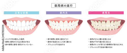 歯周病の進行　イラストセット photo