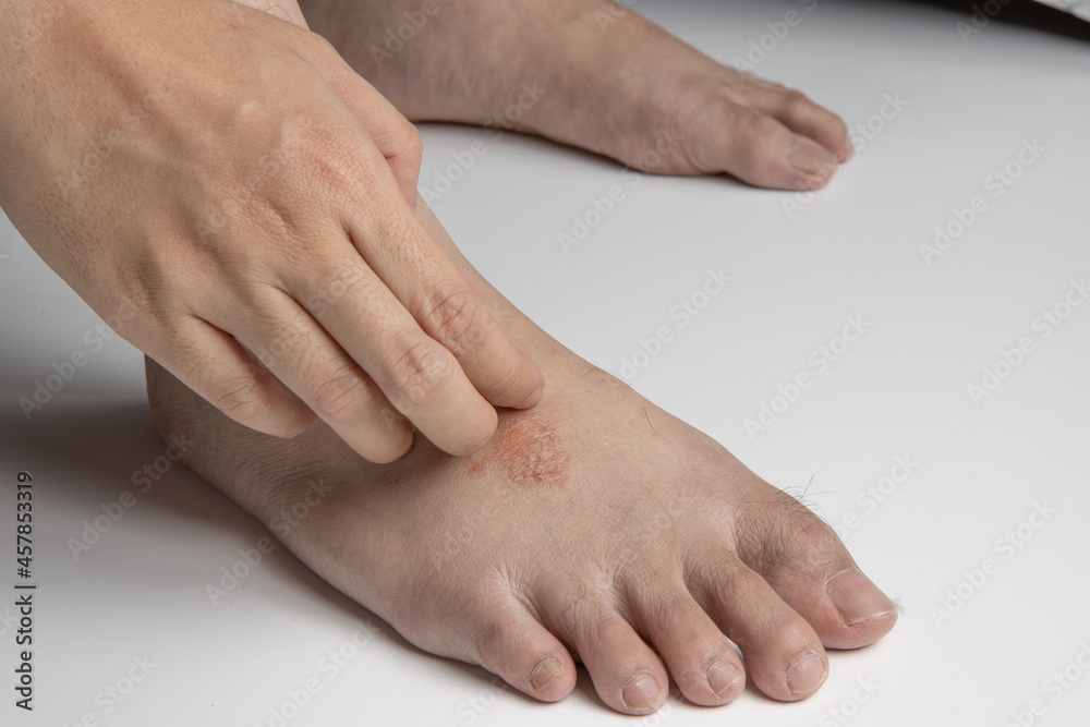 hand scratching foot infected by ringworm, athlete's foot or tinea pedis fungal infection. on white background. hand scratching foot infected by ringworm, athlete's foot or tinea pedis fungal infection. on white background.