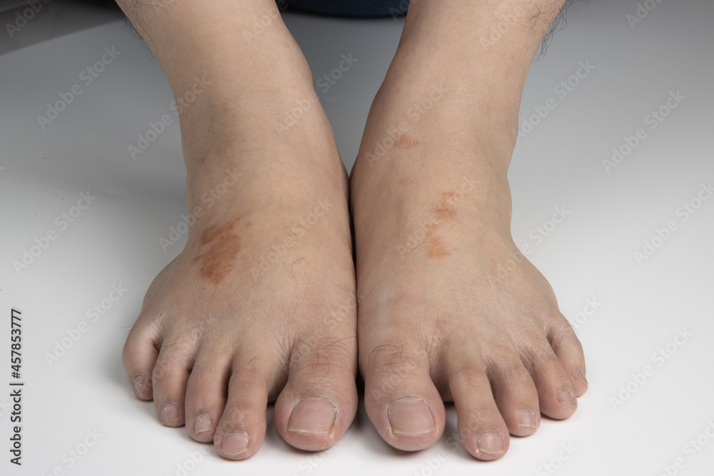 feet infected with ringworm, athlete's foot or tinea pedis fungal infection. on white background. feet infected with ringworm, athlete's foot or tinea pedis fungal infection. on white background.