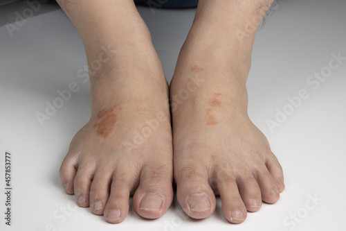 feet infected with ringworm  athlete s foot or tinea pedis fungal infection. on white background.